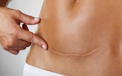 CICATRICE: IL RICORDO DI UN TRAUMA SCRITTO SUL NOSTRO CORPO.